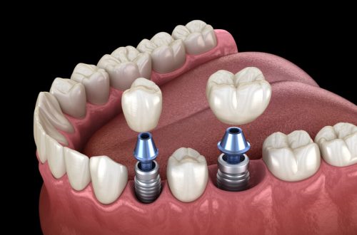 How Atmospheric Pressure Variations Impact Dental Implant Healing Processes