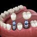 How Atmospheric Pressure Variations Impact Dental Implant Healing Processes
