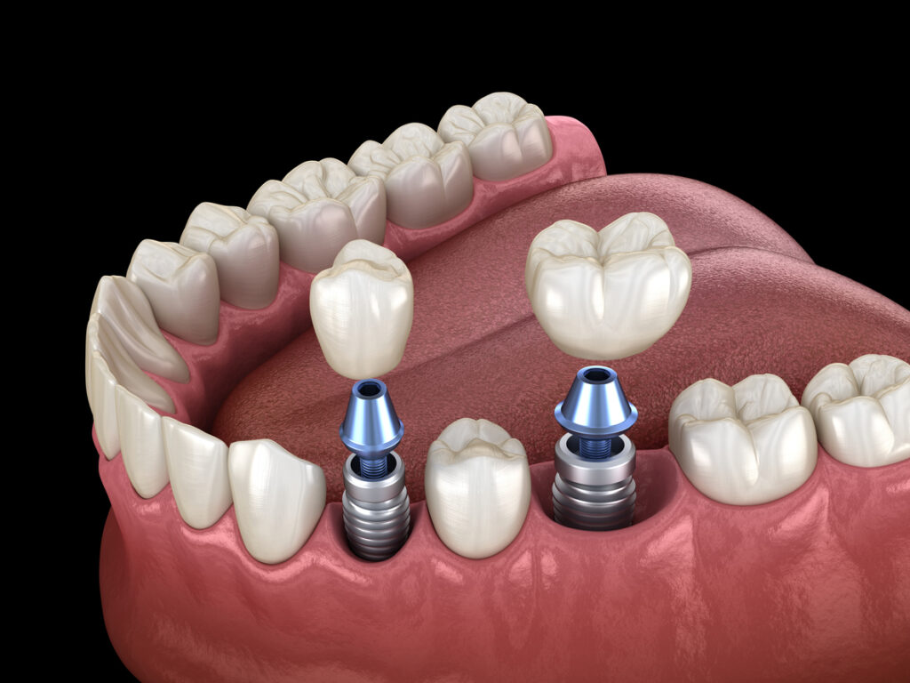 How Atmospheric Pressure Variations Impact Dental Implant Healing Processes